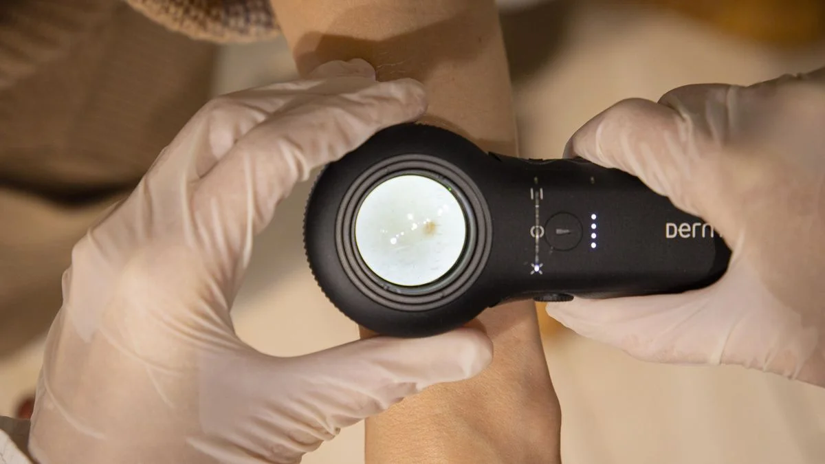 Ilustrace k článku: Češi podceňují prevenci melanomu, každý třetí byl odeslán k lékaři