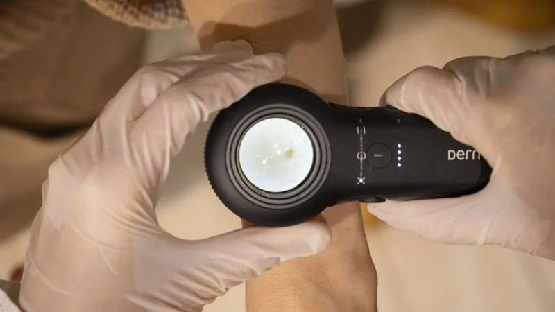 Zpráva: Češi podceňují prevenci melanomu, každý třetí byl odeslán k lékaři